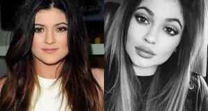 Kylie Jenner Avant et Après ses opérations de Chirurgie esthétique