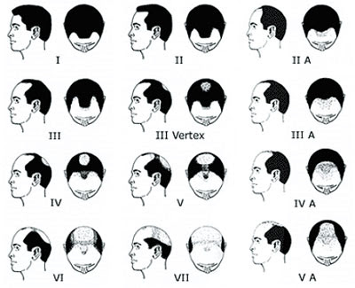 Greffe de cheveux FUT classification de NORWOOD HAMILTON