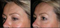 blepharoplastie avant apres