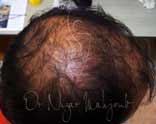 Greffe de cheveux FUT en Tunisie: Chirurgie esthétique tunisie