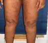 lifting cuisses apres Chirurgie esthetique Tunisie