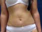 liposuccion en tunisie - lipoaspiration en tunisie - abdominoplastie en tunisie