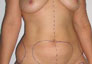 liposuccion en tunisie - lipoaspiration en tunisie - abdominoplastie en tunisie