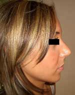 rhinoplastie, resultat apresintervention chirurgie esthétique du nez en Tunisie