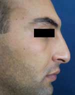rhinoplastie avant chirurgie esthétique du nez en Tunisie 