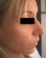 rhinoplastie avant chirurgie esthétique du nez en Tunisie